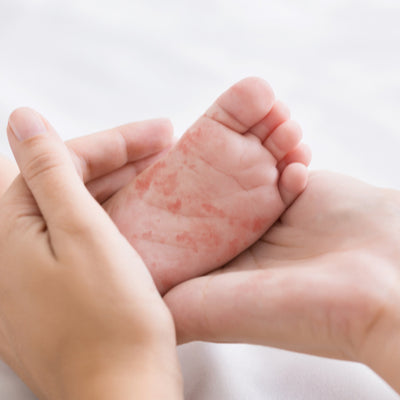 Common skin problems affecting infants