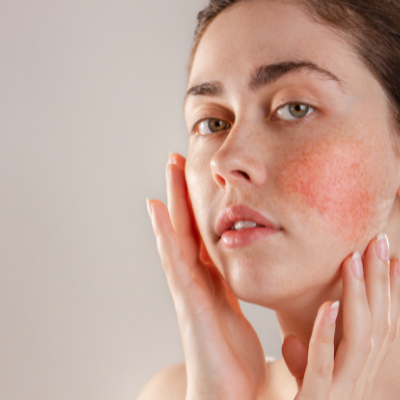 Understanding Rosacea: All You Need to Know about the Skin Condition