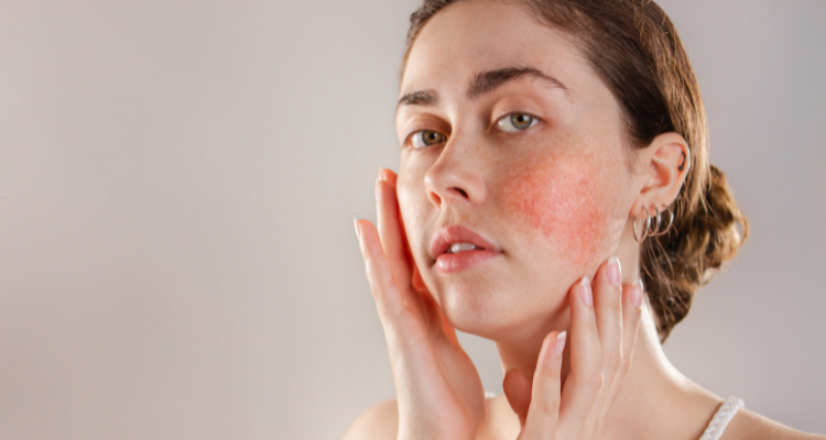 Understanding Rosacea: All You Need to Know about the Skin Condition