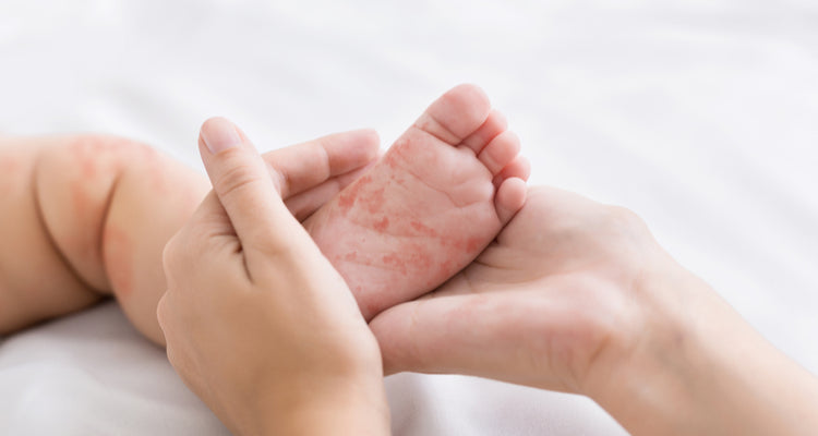 Common skin problems affecting infants