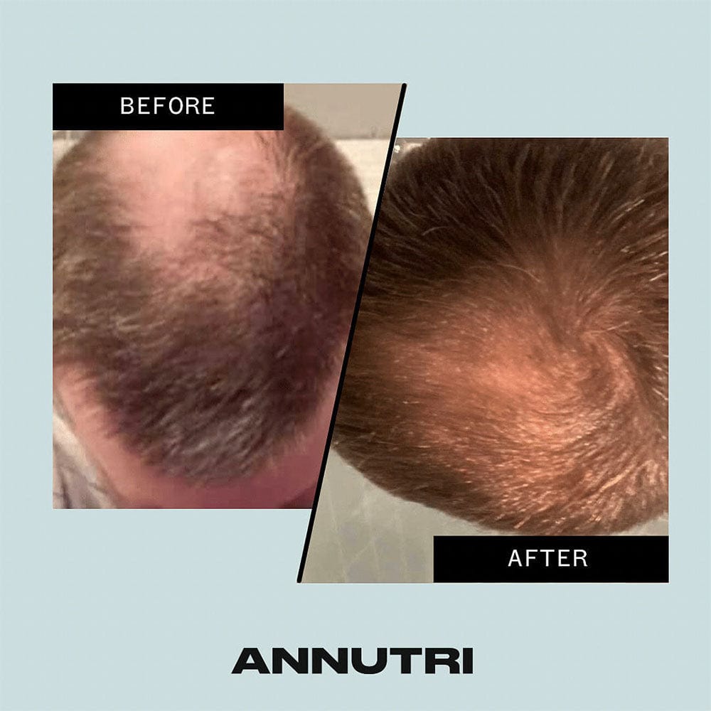 Annutri Hair Loss Treatment Annutri Grow It Hair Supplements 60 Capsules
