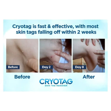 Cryotag Skin Tag Remover Cryotag Skin Tag Remover