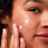 Hero Moisturiser Hero Rescue Balm Post-Blemish Recovery Moisturising Cream 15ml