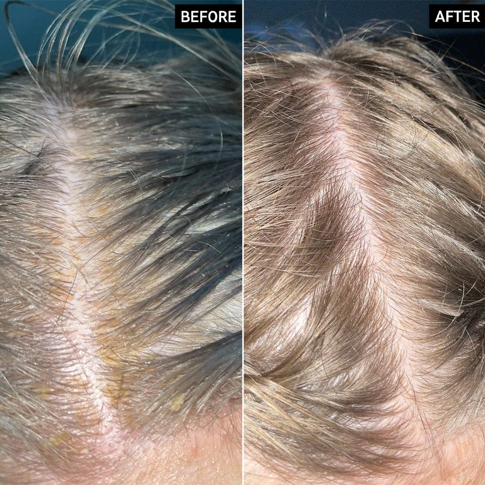 The Inkey List Scalp Treatment The Inkey List Sailcylic Acid Exfoliating Scalp Treatment 50ml