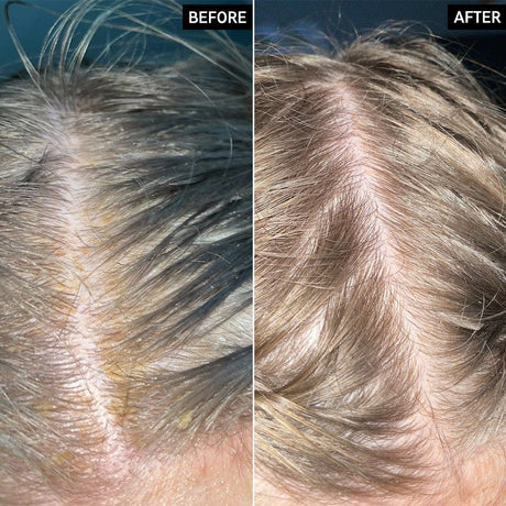 The Inkey List Scalp Treatment The Inkey List Sailcylic Acid Exfoliating Scalp Treatment 50ml